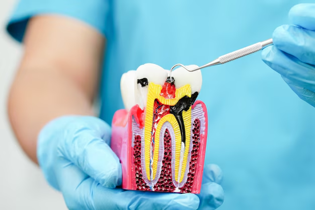 What is Root Canal Treatment?