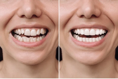 What is Cosmetic Dentistryy